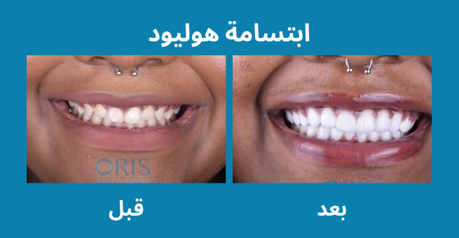 هوليوود سمايل  