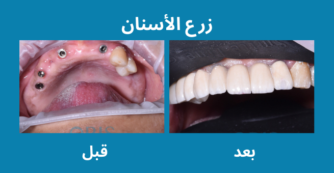 زرع الأسنان  
