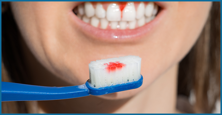 صورة تظهر تقرحات فموية