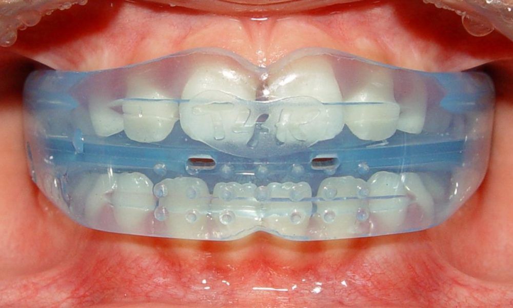 تاج الأسنان الذهبي | هل ما زال يستعمل في طب الأسنان؟؟