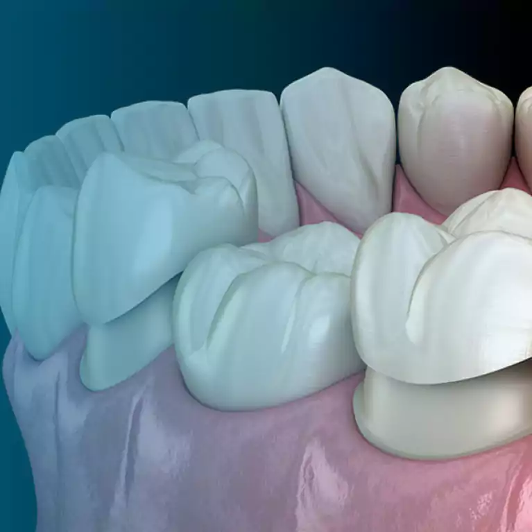 Full Ceramic Crowns