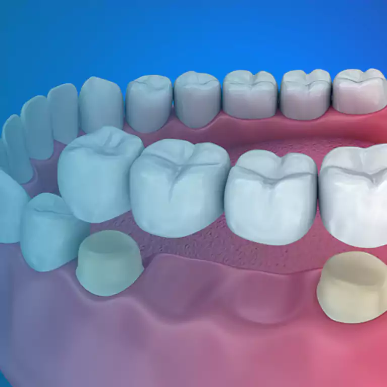 Dental Bridges