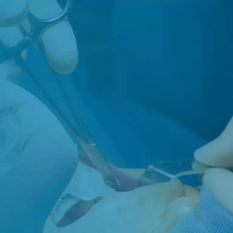 Surgical Tooth Extraction