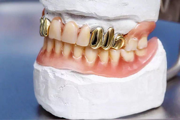 تاج الأسنان الذهبي | هل ما زال يستعمل في طب الأسنان؟؟