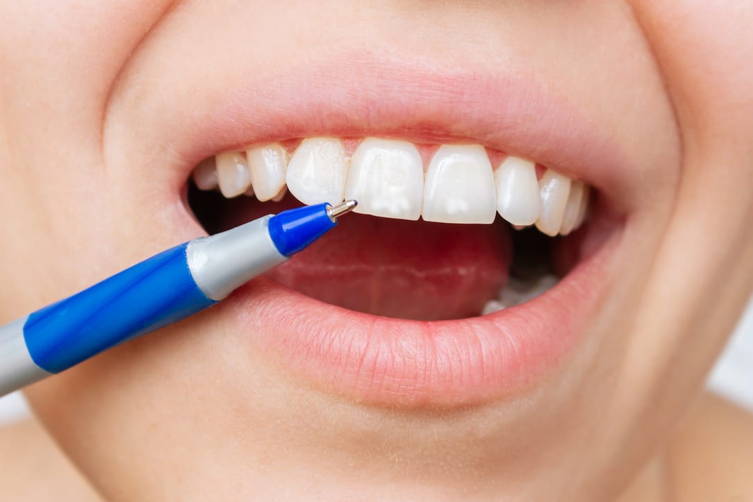 ما الذي يجب أن تعرفه عن تطعيم عظم الفك تحضيراً لزراعة الأسنان