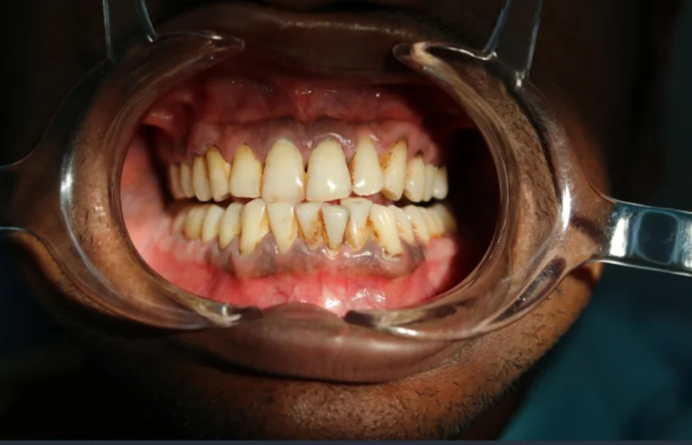ما هي حالة فرط عدد الأسنان (Hyperdontia)