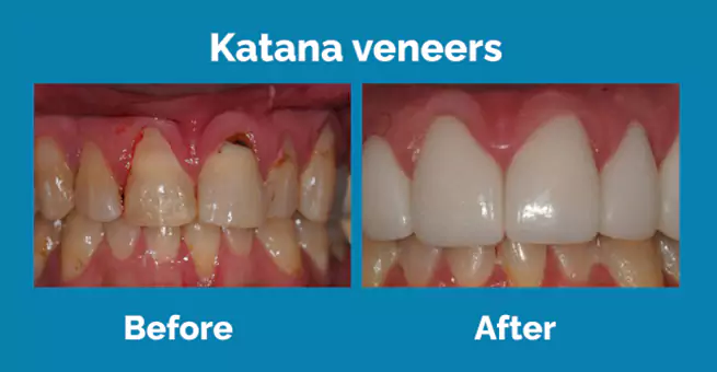 katana-veneers (1)
