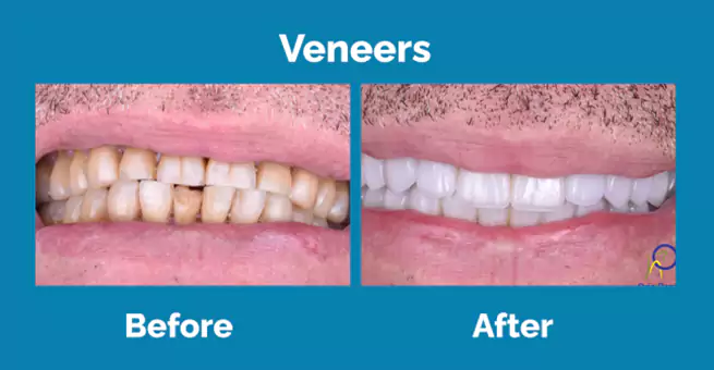 veneers1