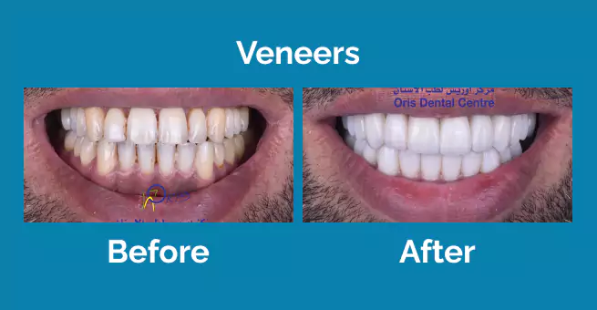 veneers2