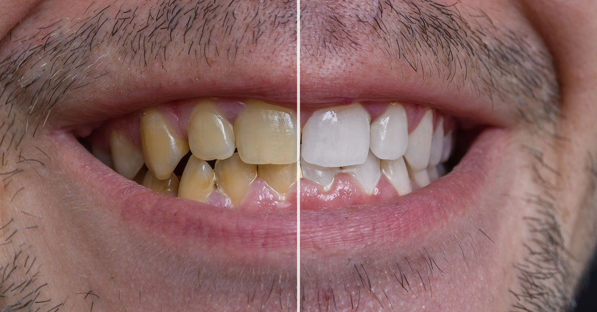 What Does Full Mouth Reconstruction Includes