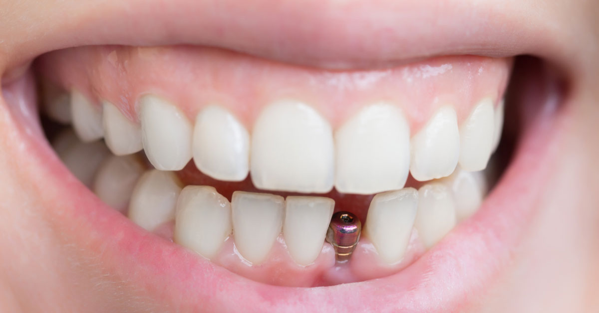 Lost a Tooth Here’s How Single Tooth Implant Can Benefit You