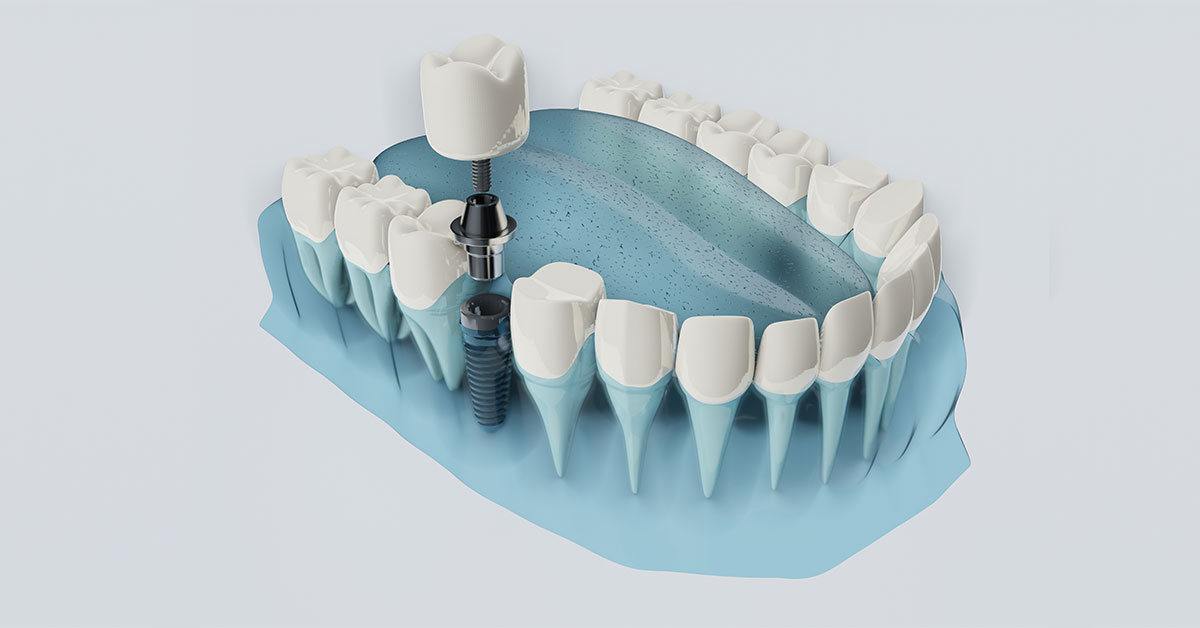 More Information on Immediately-loaded Dental Implants | Dental Implants in Dubai
