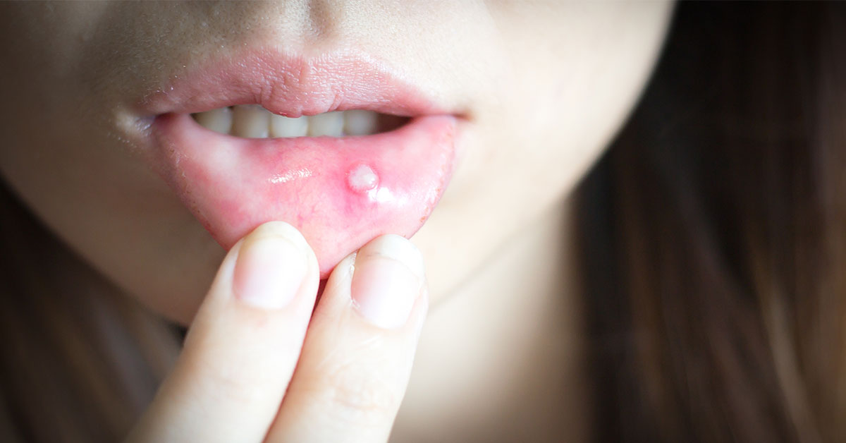 Recurrent mouth ulcers | Dental Hygiene