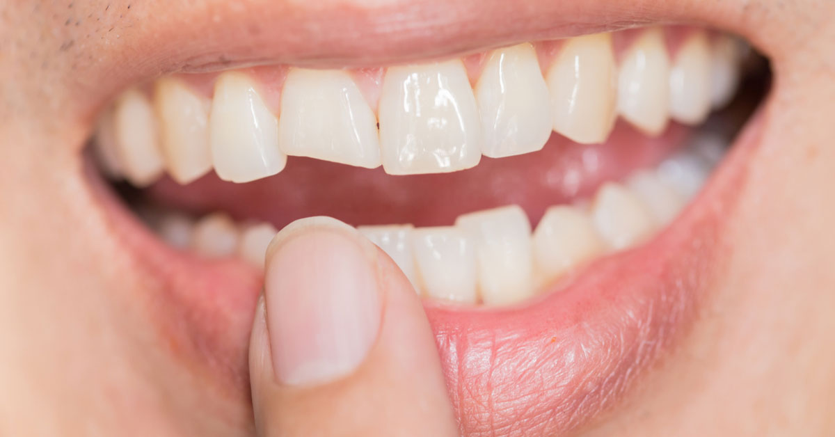 What is Gum Depigmentation and how is it treated?