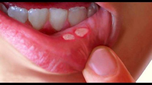 Recurrent mouth ulcers