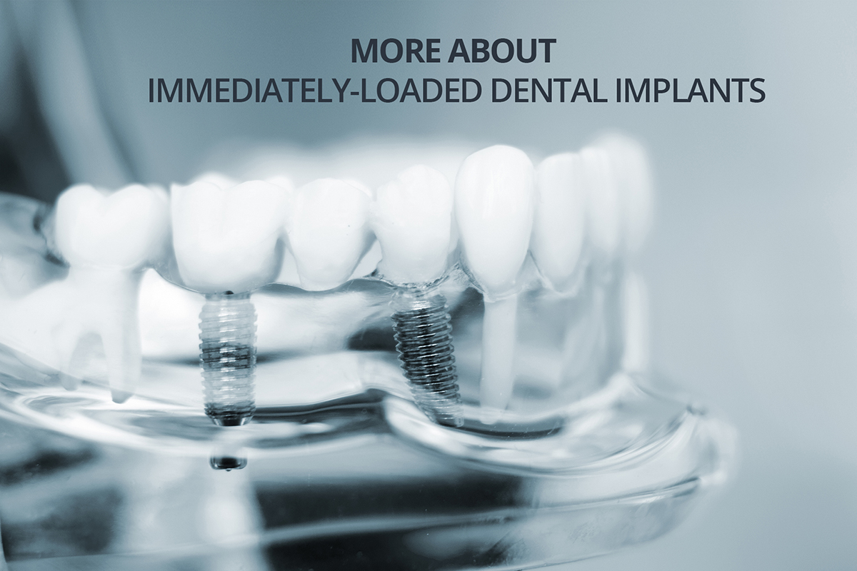 More about Immediately Loaded Dental Implants