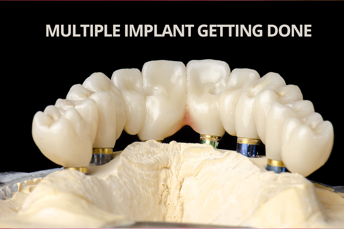Immediately- loaded Multiple Dental Implants