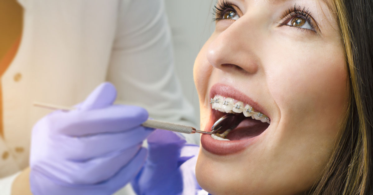 Braces and loosening of teeth | Orthodontics In Dubai