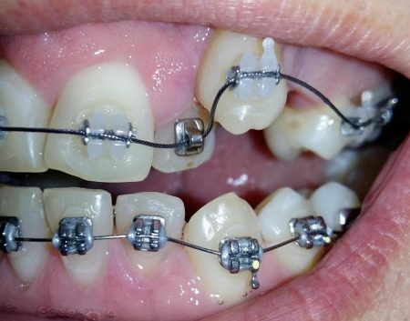 Metallic brace
