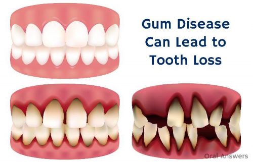 Teeth loss caused by gum diseases