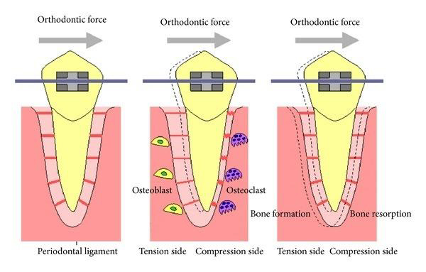 Orthodontic force given by braces to straigthen teeth