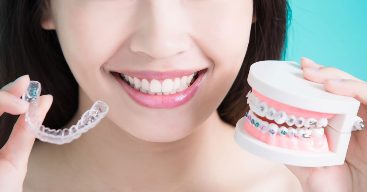 Clear Aligners versus Traditional Braces | Orthodontics In Dubai