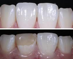 Porcelain Veneers