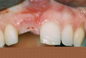 Missing Tooth