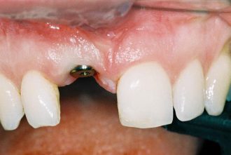 Fixing immediate loaded implant