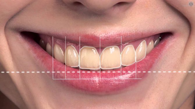 Digital Smile Designing 