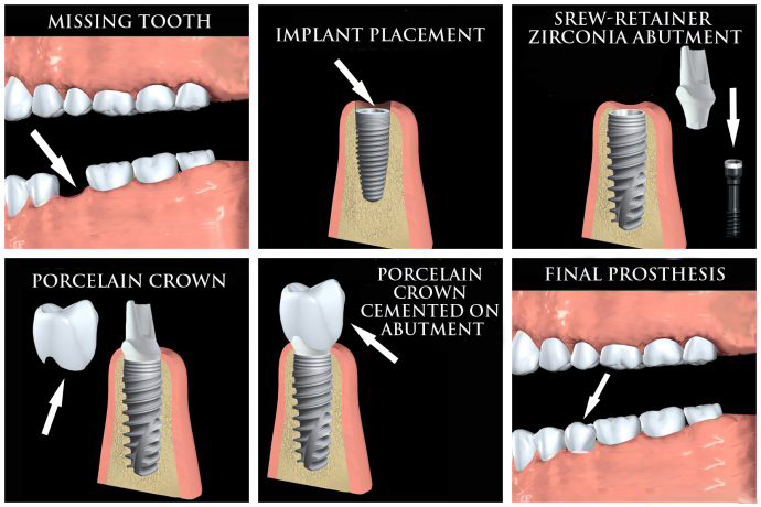 tooth implants procedure