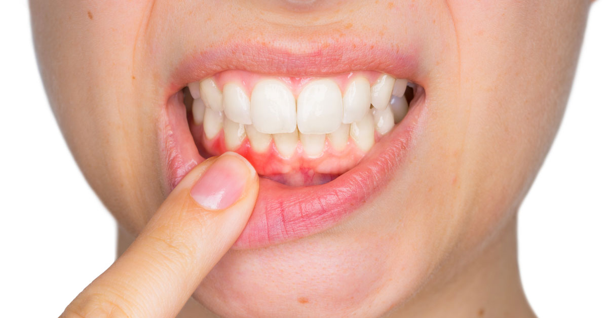 Gum Disease and its management | Dental Hygiene
