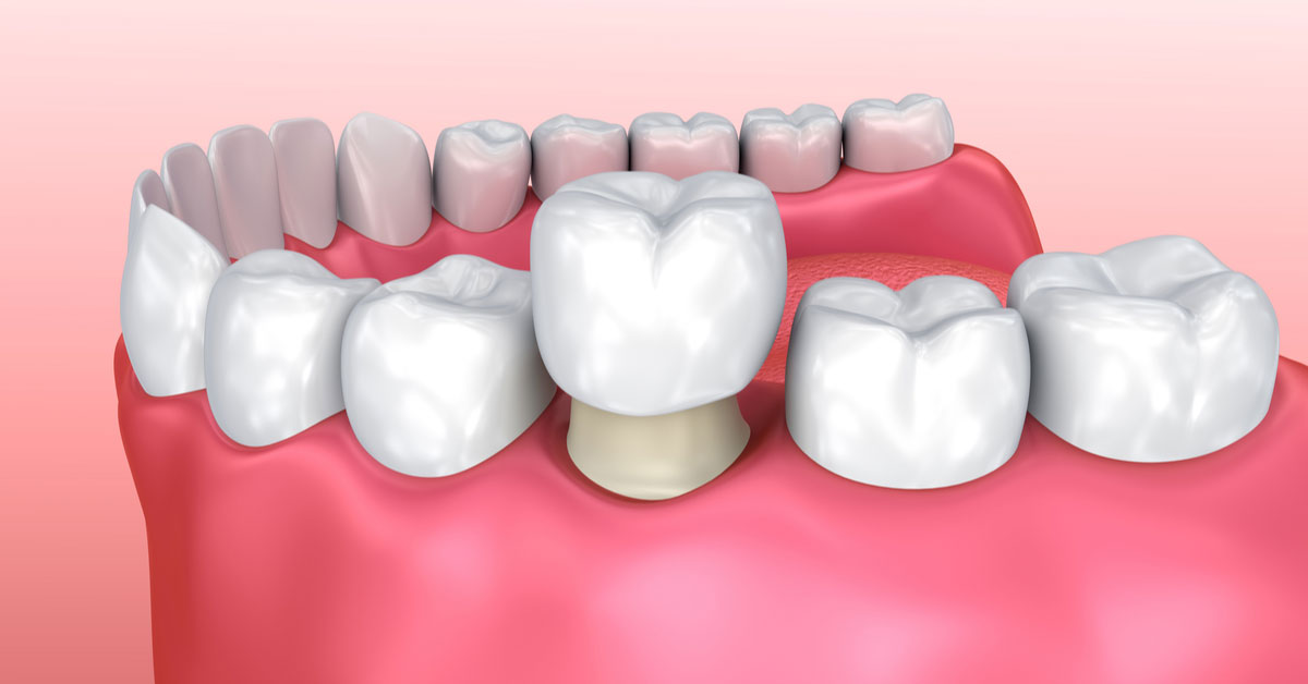 CEREC dental restorations – their advantages over conventional crowns