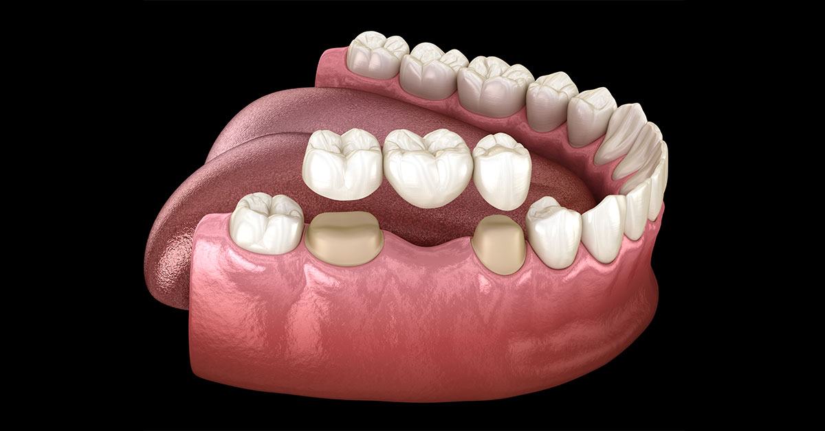 Dental Crowns and Bridges – royal replacement of your missing teeth