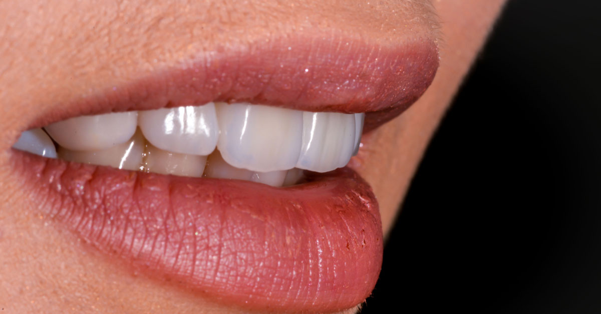 Zirconia Crowns – their indications and uses