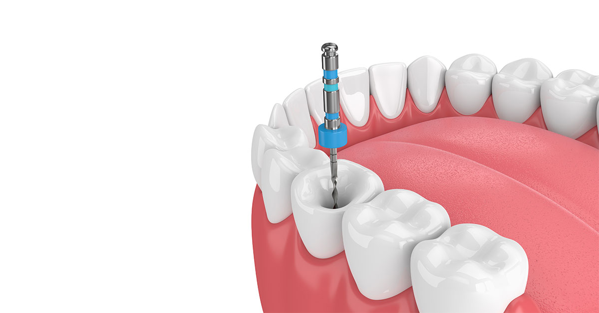 Some frequently asked questions about Root Canal Treatment