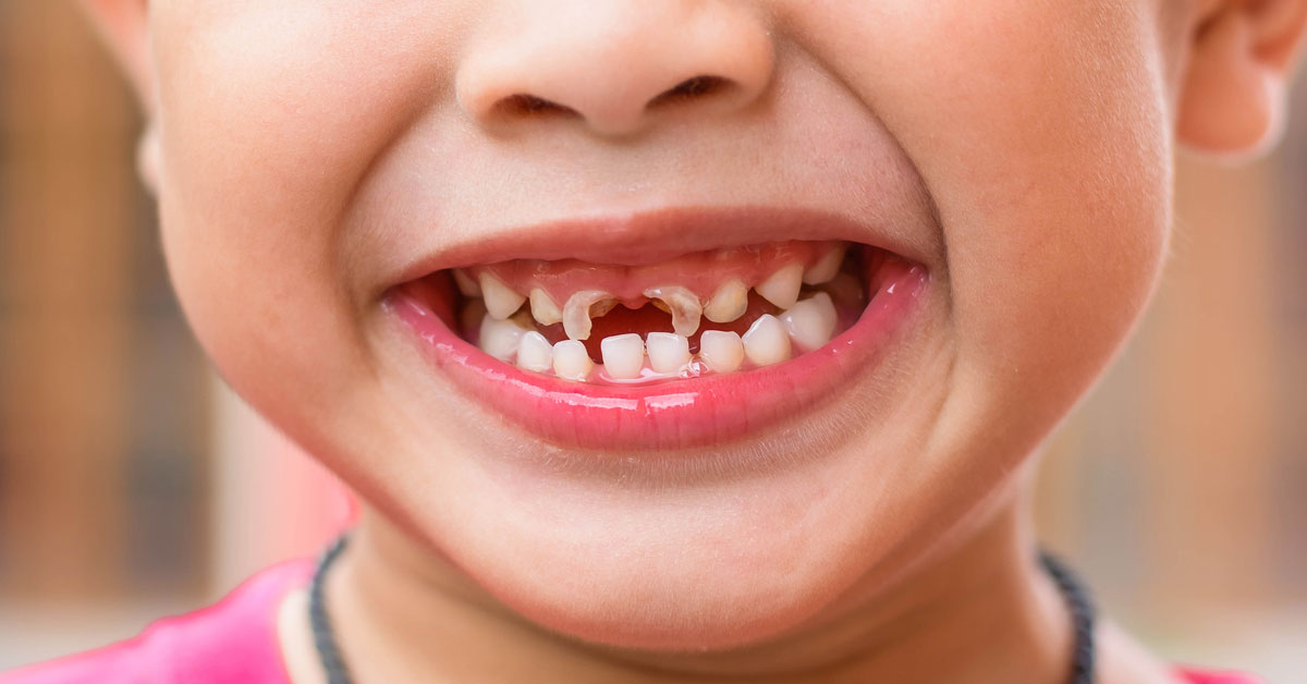 How to prevent tooth decay in kids | Pediatric Dentist in Dubai