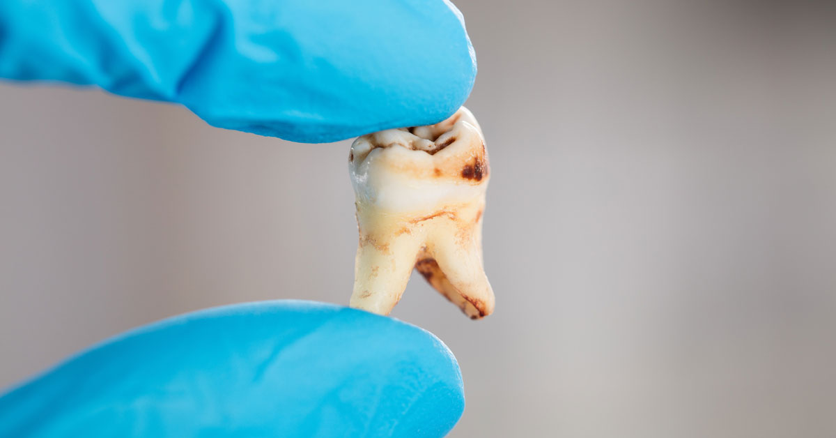 Early caries intervention is the best way to deal with decayed tooth