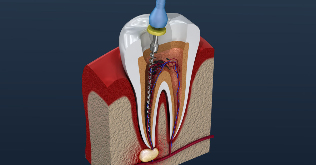 Root Canal therapy – A brief look out | ROOT CANAL TREATMENT IN DUBAI