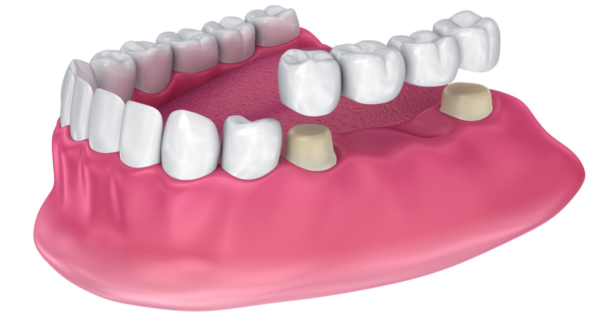 All you need to know about dental bridges In Dubai