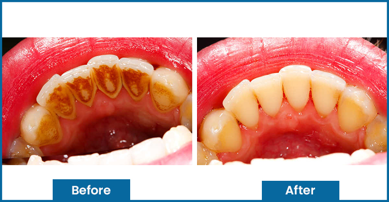 plaques before and after