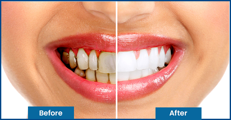 white teeth before after