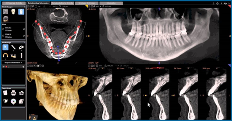 CBCT – Cone Beam Computed Tomography