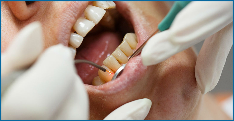 Gum Line Countoring 2