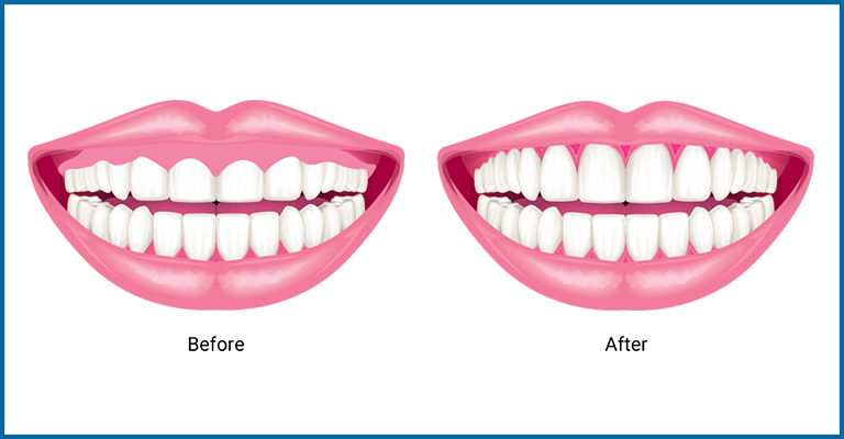 Gum Line Countoring before & after