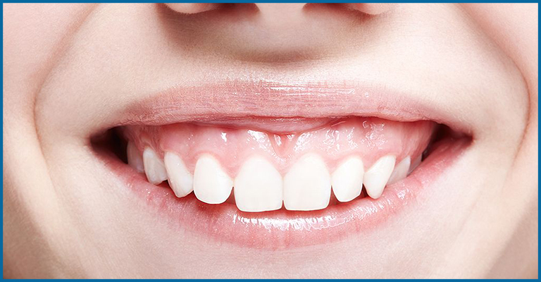 patient with exposed gums