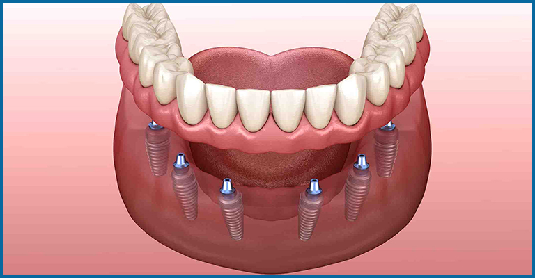 How are implant supported dentures processed on patients at Oris dental center 2