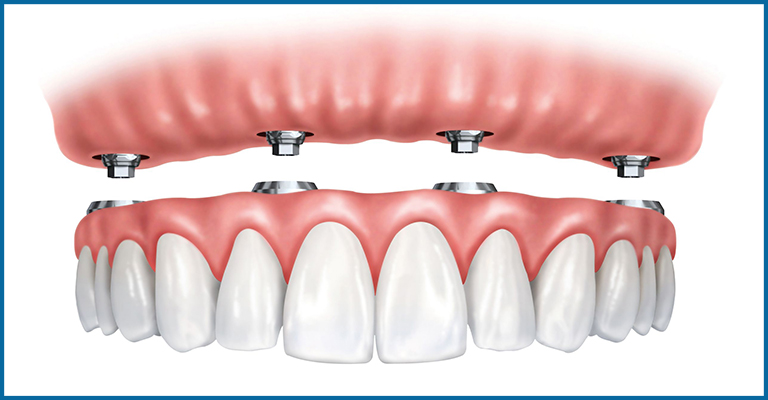 How are implant supported dentures processed on patients at Oris dental center