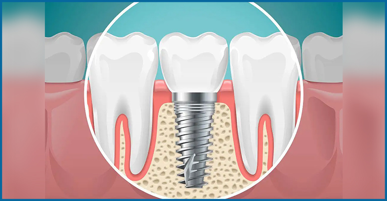 titanium implant