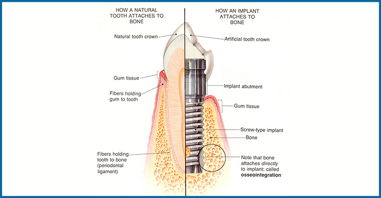 implant abutment